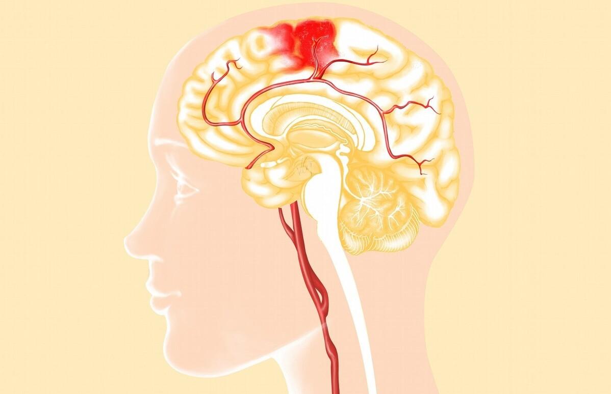 高血压脑出血突然发作该如何急救,高血压脑出血晕倒一小时急救