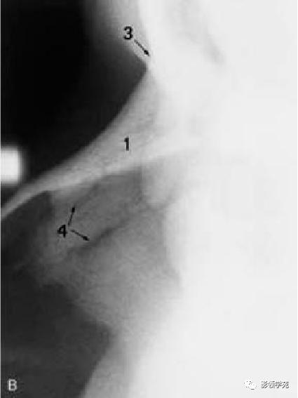 鼻骨骨折的检查方法,鼻骨骨折影像学表现