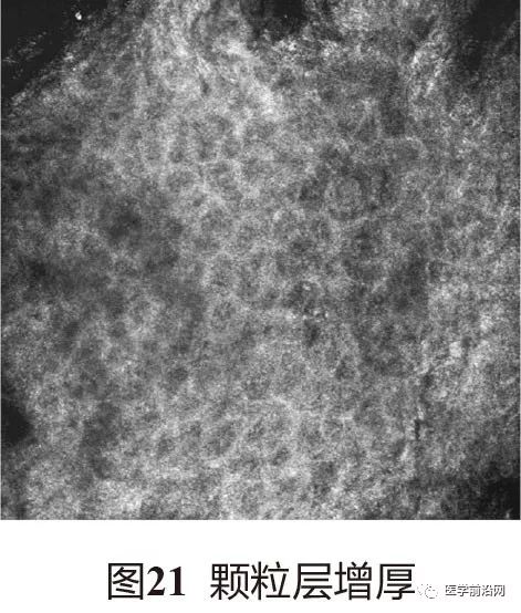 炎症性皮肤病反射式共聚焦显微镜诊断特征专家共识全文发布