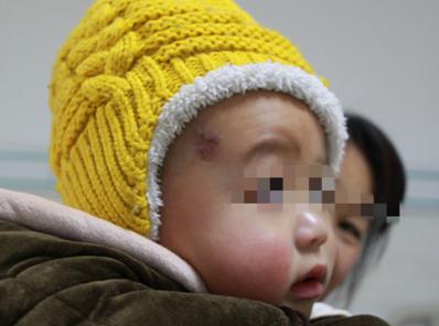 混合型血管瘤的治疗办法,混合型血管瘤的最佳治疗方法