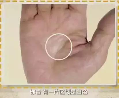 手的健康识别,看手识病疾病自测