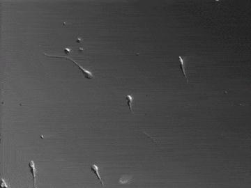 严重弱精症和完全无活动精子的原因是啥？