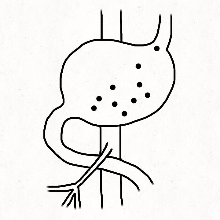 肠系膜上动脉综合征治疗,肠系膜上动脉综合征ct表现