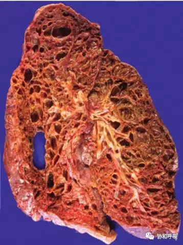 24岁女孩患了一种罕见的病,女性罕见病有哪些症状