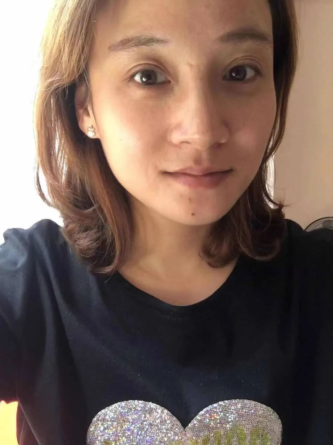 面部不对称程度怎么界定,高低肩会影响面部吗