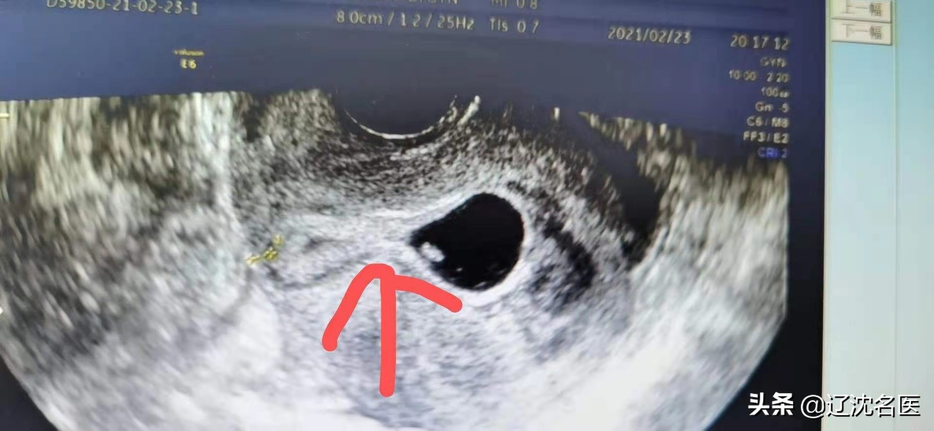 怕疼的话还是选择剖腹产,剖腹产4种疼痛方法