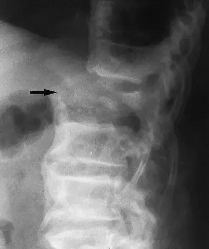 神经性骨关节病,神经性关节炎症状图片