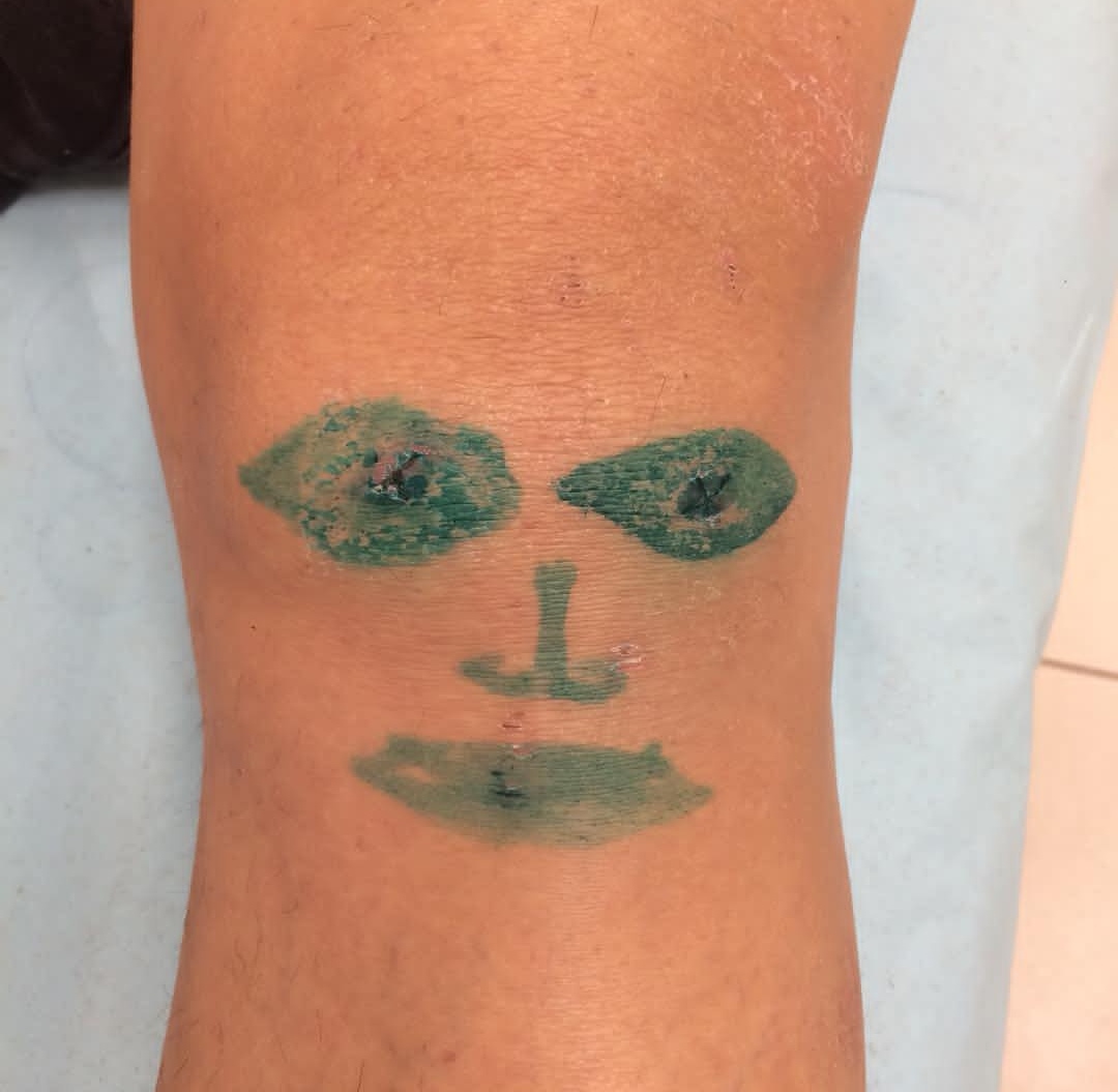 膝盖疼、老寒腿、长骨刺，关节炎了怎么办？45个短问，彻底讲清