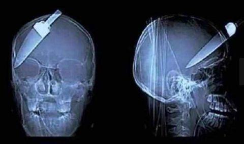 不作死就不会死，看看这些被人类搞进身体里的异物