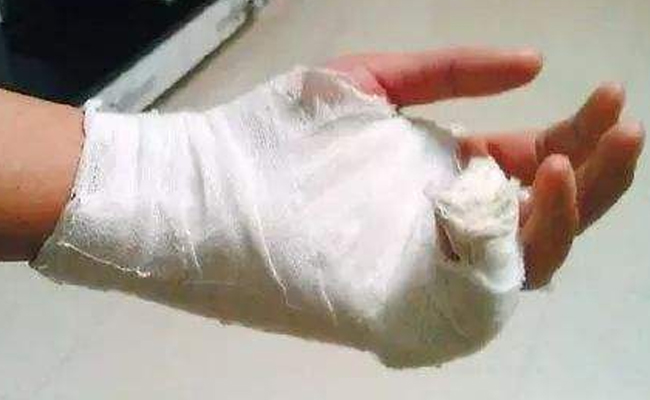 澳洲疤痕膏能去掉疤痕吗,澳洲祛疤膏适合哪些疤痕