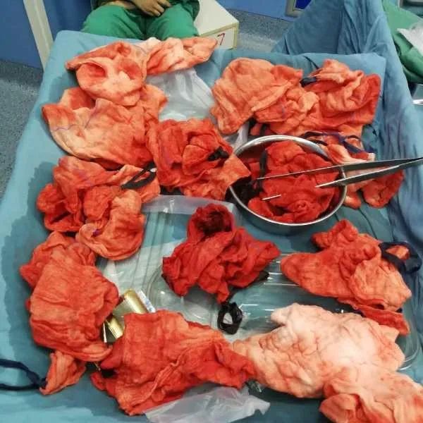 产妇大出血事件最新消息,生完孩子产妇大出血死亡