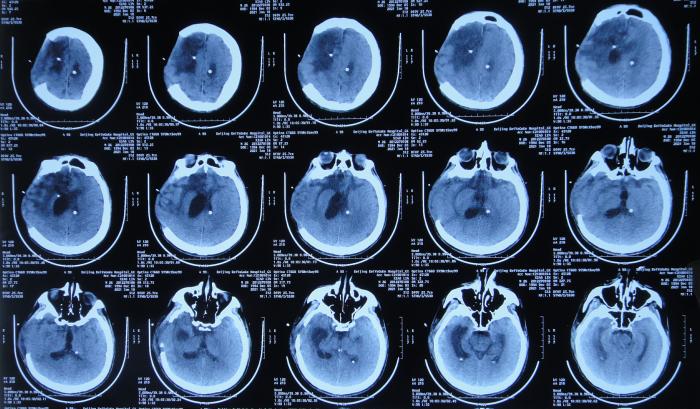 开颅手术后颅内细菌感染图片,外伤开颅手术后脑积液能恢复吗