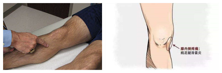 膝关节鹅足,有一种膝关节痛叫鹅足发炎