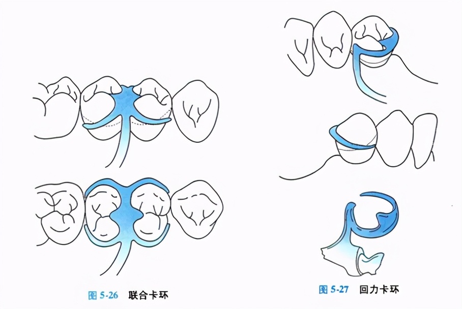 牙列缺损的可摘局部义齿修复题库,牙科美学修复精讲