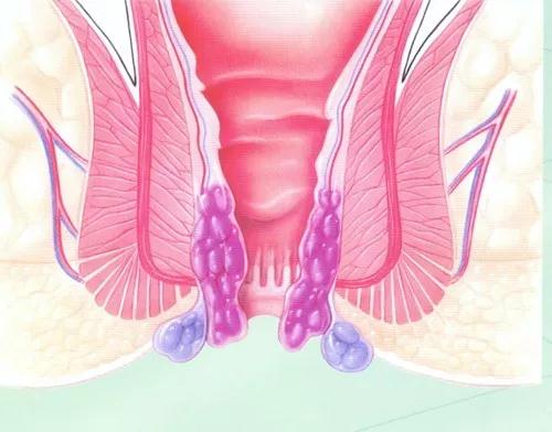 肛裂会引起什么疾病,肛裂能彻底痊愈吗