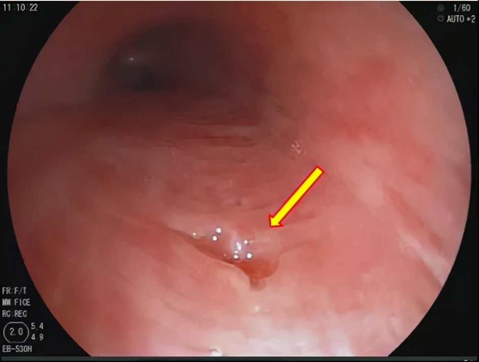 一碗鱼汤,让她反复咳嗽、发烧,还发生了食管、气管“短路”