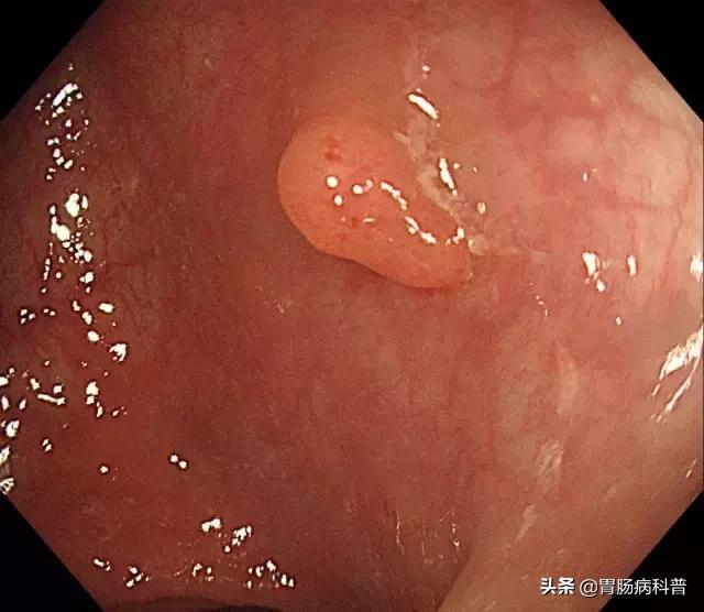 长了胃息肉怎么办,长了胃息肉怎么办才好