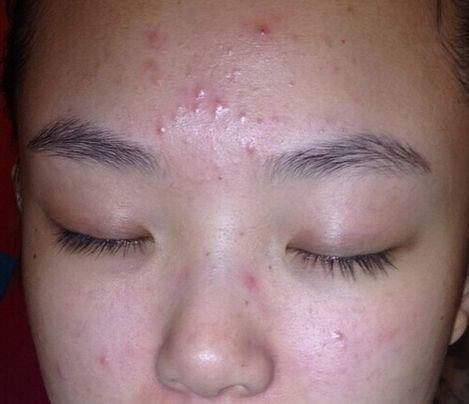 毛囊炎最好的内服药排名,有治疗毛囊炎的特效药吗