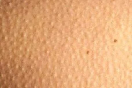 皮肤毛周角化怎么治疗最有效,油性皮肤毛周角化能好吗