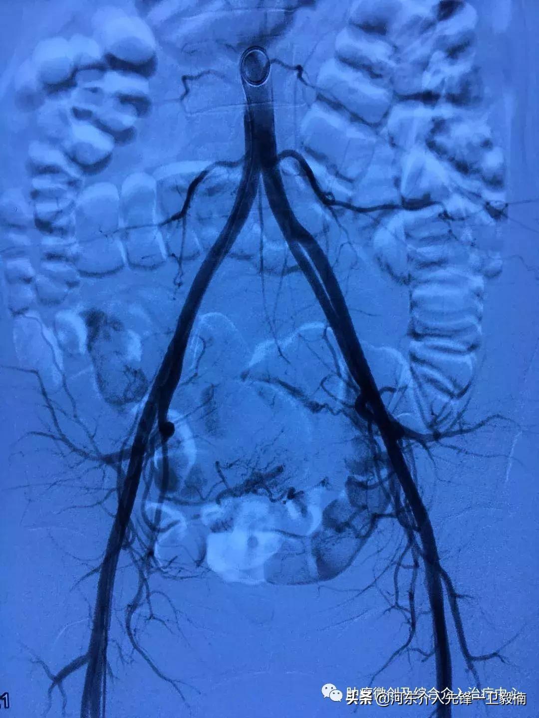 运城市第一医院肿瘤介入科,子宫肌瘤微创手术是超声介入吗