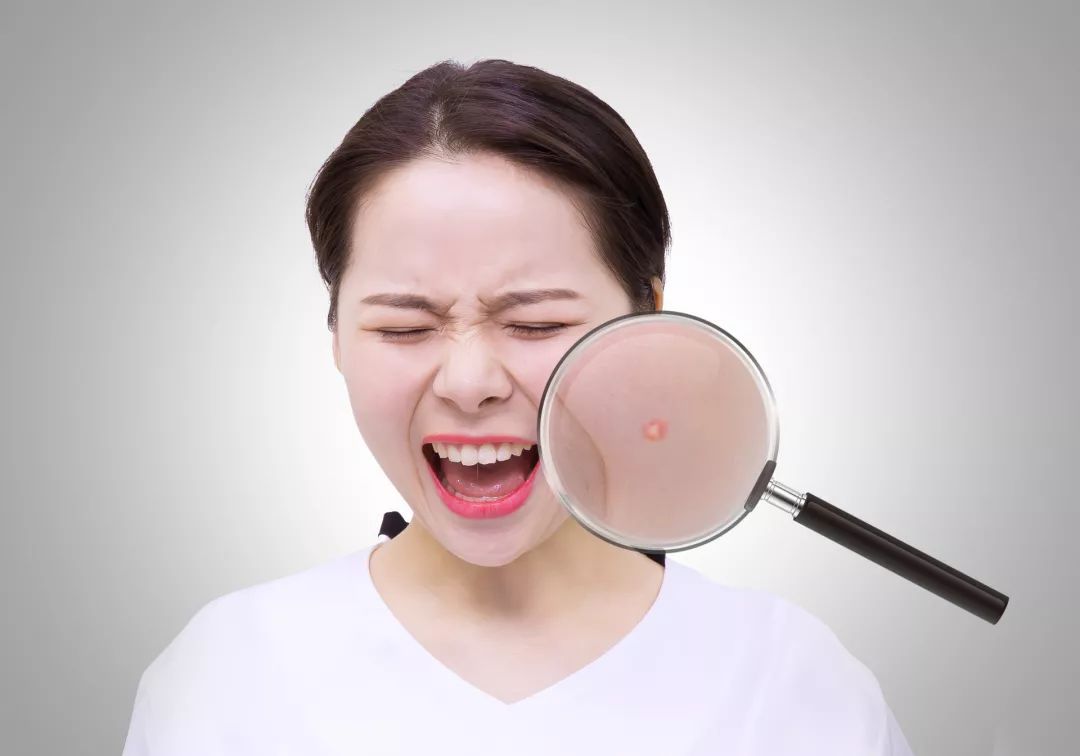 祛除粉刺闭口痘印的方法真实有效,祛除痘印闭口推荐什么产品