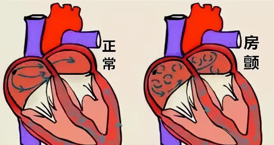 心房颤动会引起头部发麻,突发心房颤动与高血压的关系