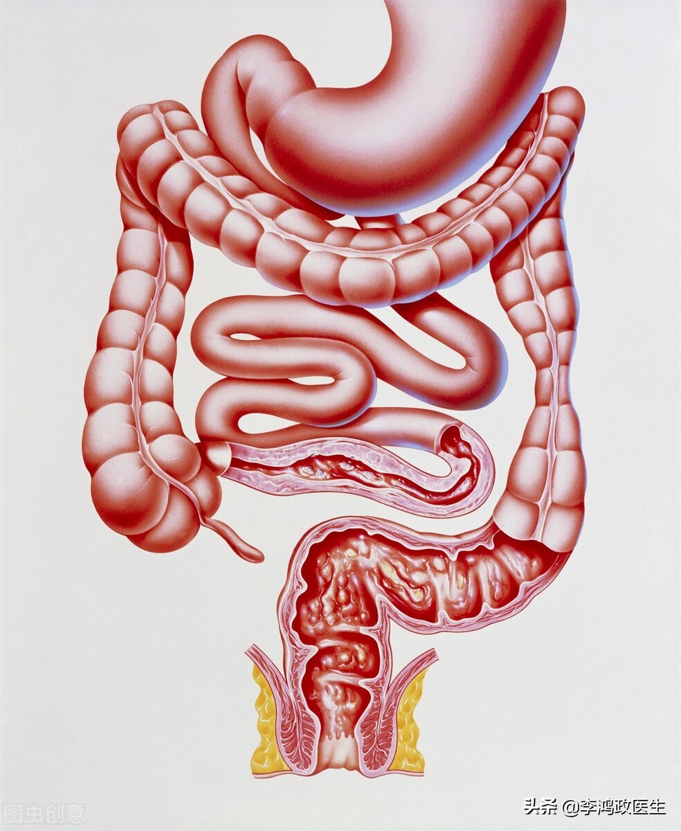 拉肚子便血了是癌症吗,长期腹泻便血是不是癌症晚期