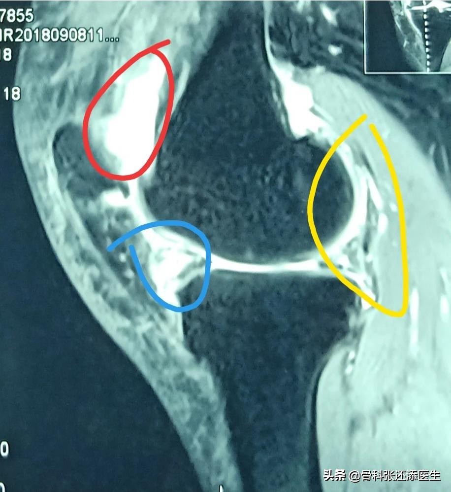 花椒和白醋对关节炎积液有效果吗,盐加花椒热敷膝关节积液管用吗