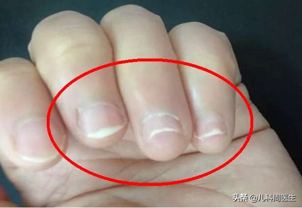 孩子轻微缺钙缺锌需要补多长时间,孩子缺钙缺锌是长不高的原因