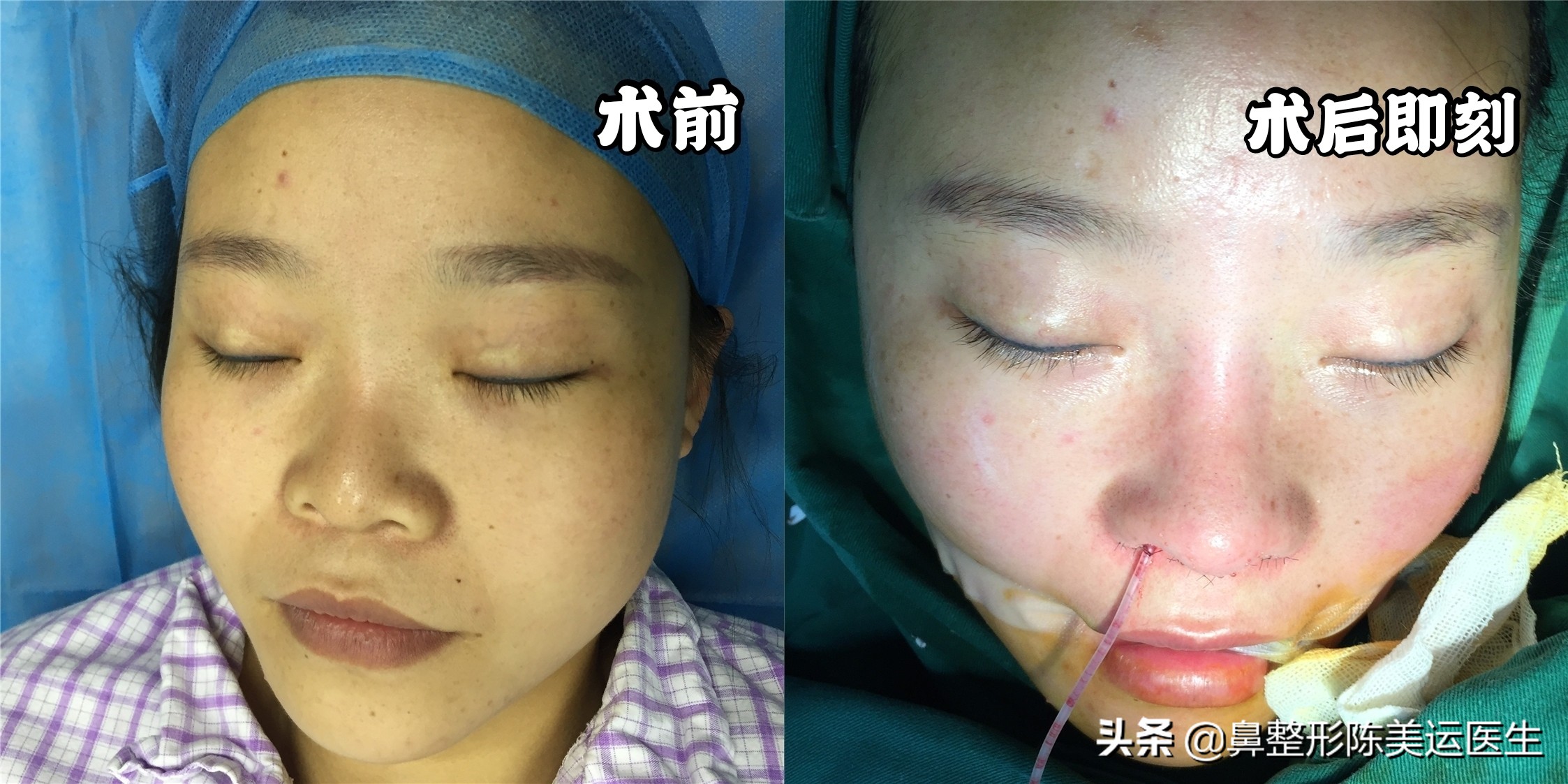 幼儿园鼻子扁平塌图片,如何矫正鼻子扁塌