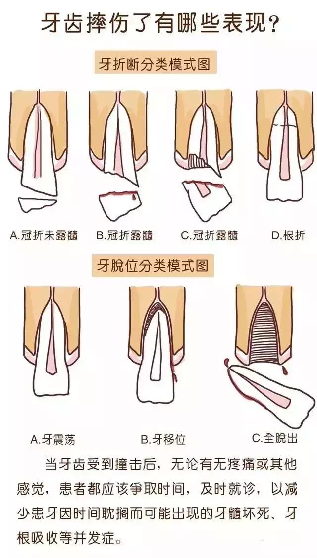 儿童摔断牙齿怎么治疗,孩子摔断门牙后该如何处理