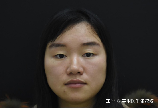 贴了双眼皮贴后的真实效果,贴双眼皮贴容易起翘