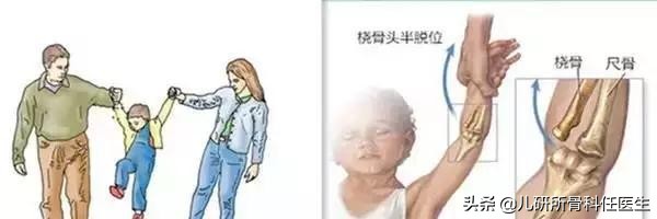 孩子出门玩耍担心牵拉肘？爸爸妈妈看这一篇就够了