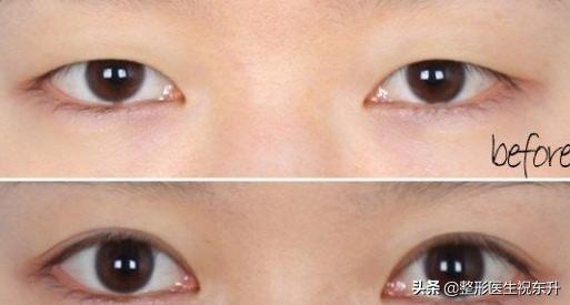 矫正上睑下垂的手术没有效果,上睑下垂矫正手术后听到嘣的一声