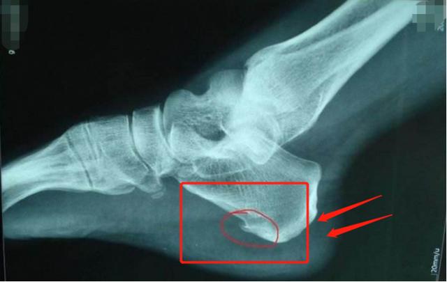 脚后跟痛最好的治疗方法真实有效,脚后跟痛的最佳治疗方法是什么