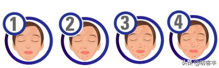 青春痘怎么治学生党不用花钱,青春痘怎么治疗最好高中学生