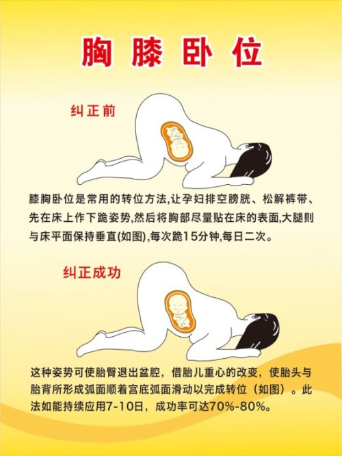 胎位不正怎么办？28周以上孕妇都需要了解，妇产科医生教你纠正