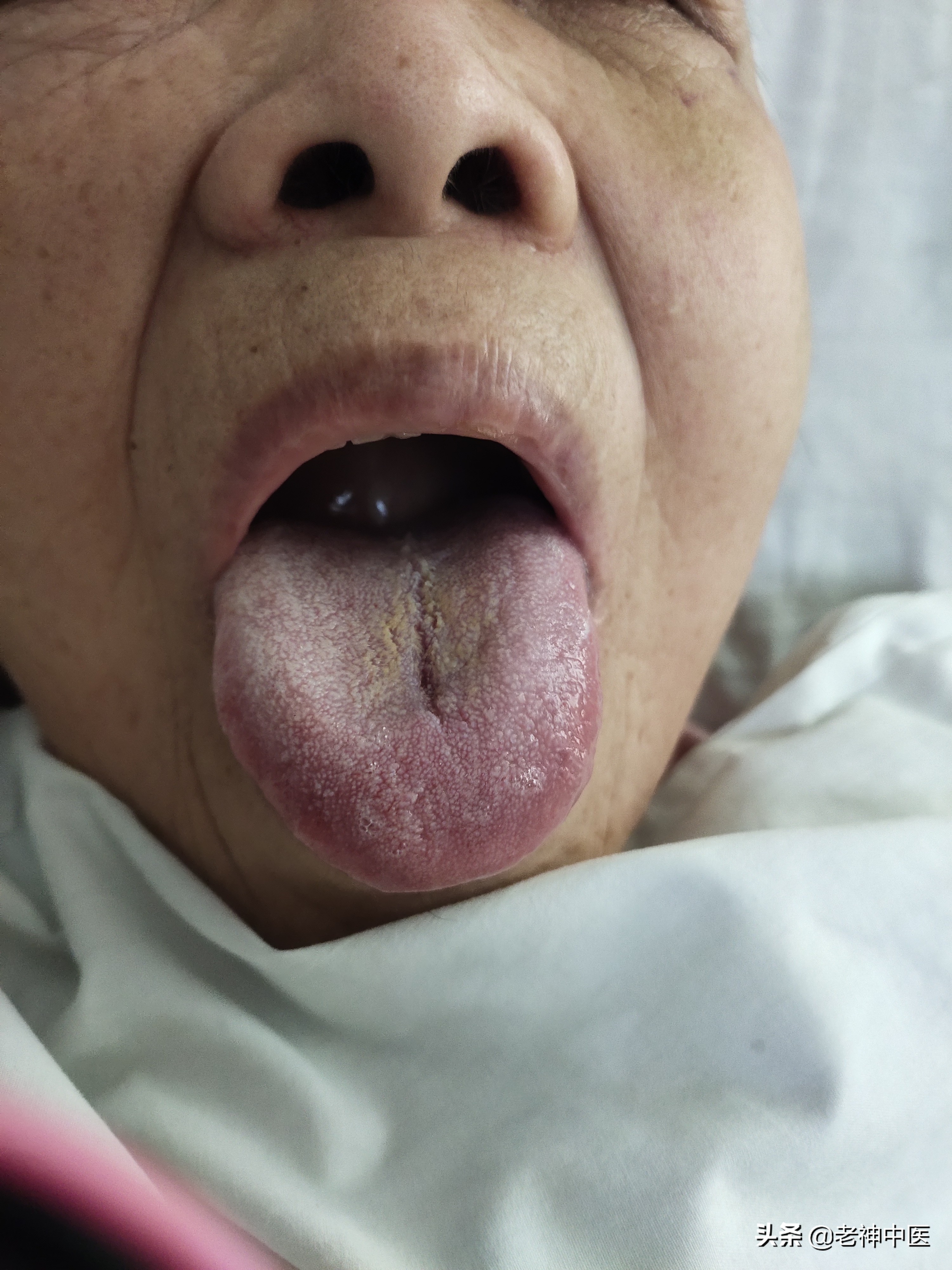 老人支气管肺炎咳嗽特效药,老人肺炎咳嗽痰多有什么特效药