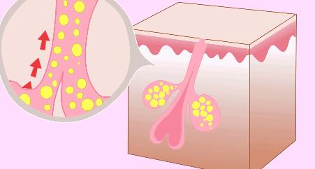 毛孔粗大怎么办,毛孔粗大怎么办什么方法最有效