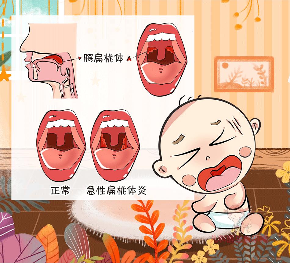 扁桃体发炎把扁桃体切掉可以吗,扁桃体发炎把扁桃体切掉