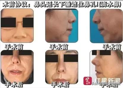 整形要谨慎女子整形失败上班被拒,女子花6万多整容后续