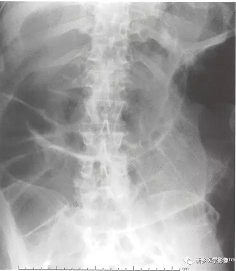 辨识肠梗阻,肠梗阻死亡前兆