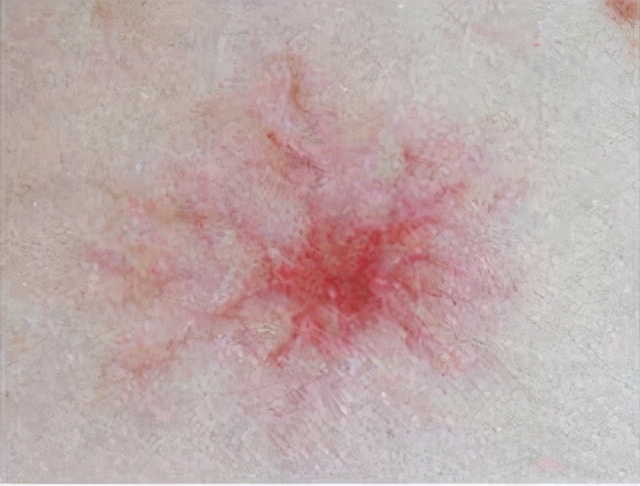 身上的小红点是不是代表得了肝病,身上有红点是肝病的前兆吗