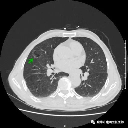 多发原发肺癌能根治吗,肺部原发性恶性肿瘤好治