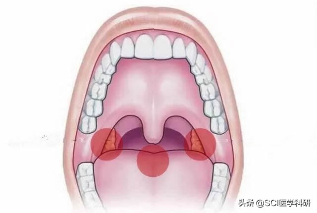 鱼刺卡气嗓怎么取出,鱼刺卡喉的最佳解决方法