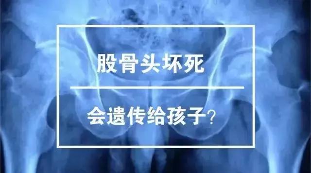 女人股骨头坏死遗传几率大吗,股骨头坏死对生育有没有影响