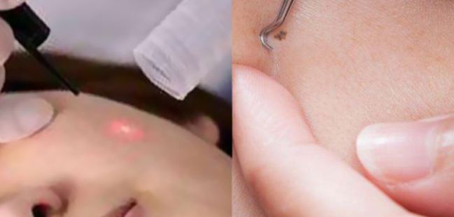 到底要不要祛痣,该不该去医院点痣