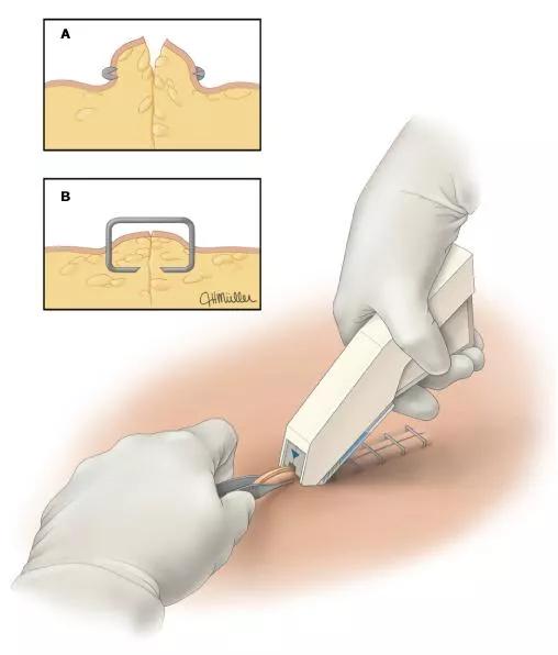 伤口美容缝合跟普通缝合比较图,皮肤缝合的手法
