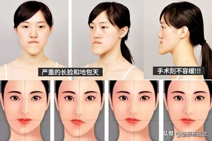 改变脸型除了削骨还有其他办法吗,国字脸磨骨成瓜子脸