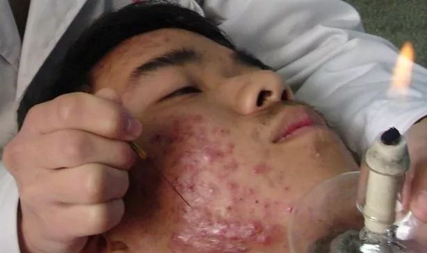 中医火针疗法教学视频,火针操作手法